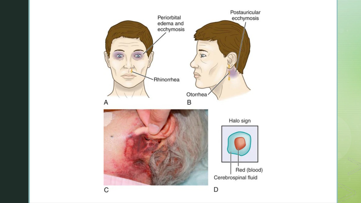 Battle's sign and raccoon eyes. Both are bruising in a characteristic distribution rather than at the point of impact, which is what makes them useful - they point to a basilar skull fracture underneath. The chapter notes these findings evolve over several hours, so their absence on arrival proves nothing.