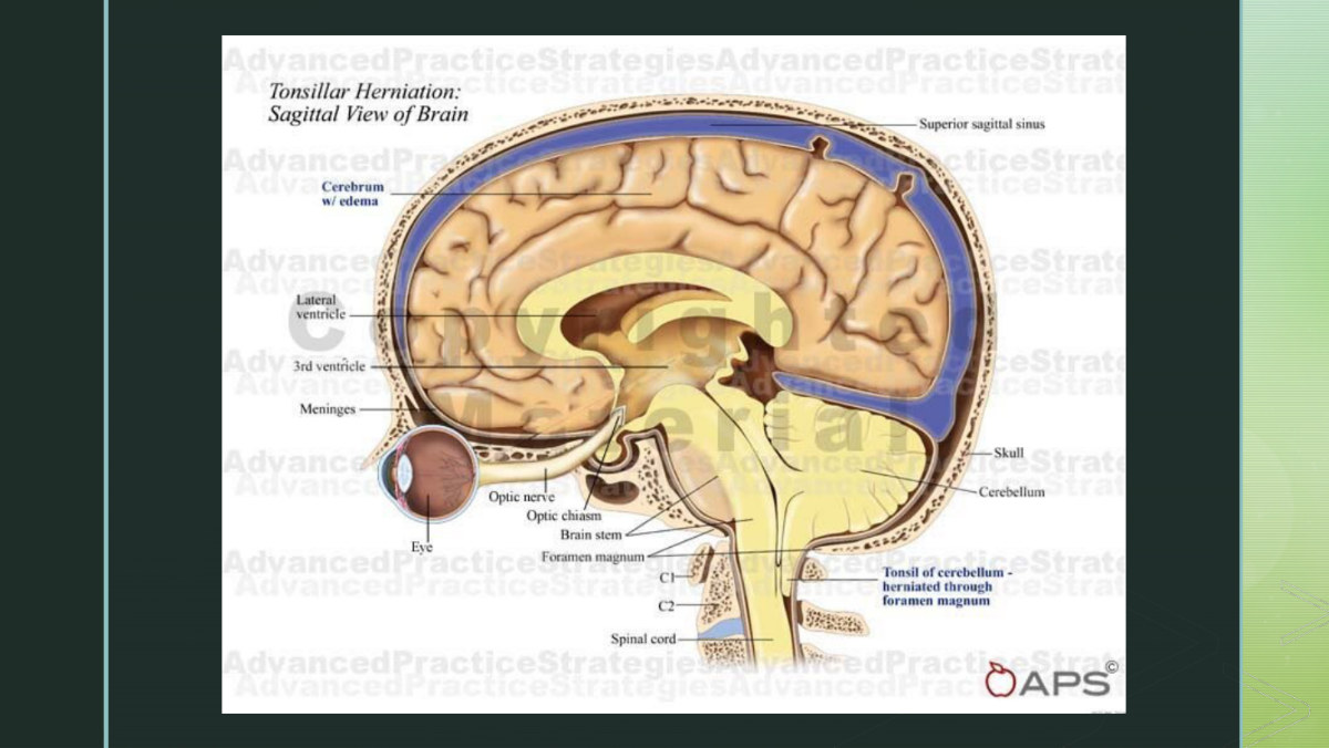 Herniation syndromes - tissue driven across compartments it does not belong in. She narrated the cerebellar tonsil being pushed down through the foramen magnum here. Note that the compartments are separated by folds of dura, not by bone; the dura is what makes the shift damaging.